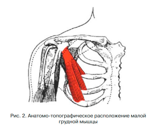 Рис. 2. Анатомо-топографическое расположение малой грудной мышцы