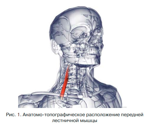 Рис. 1. Анатомо-топографическое расположение передней лестничной мышцы