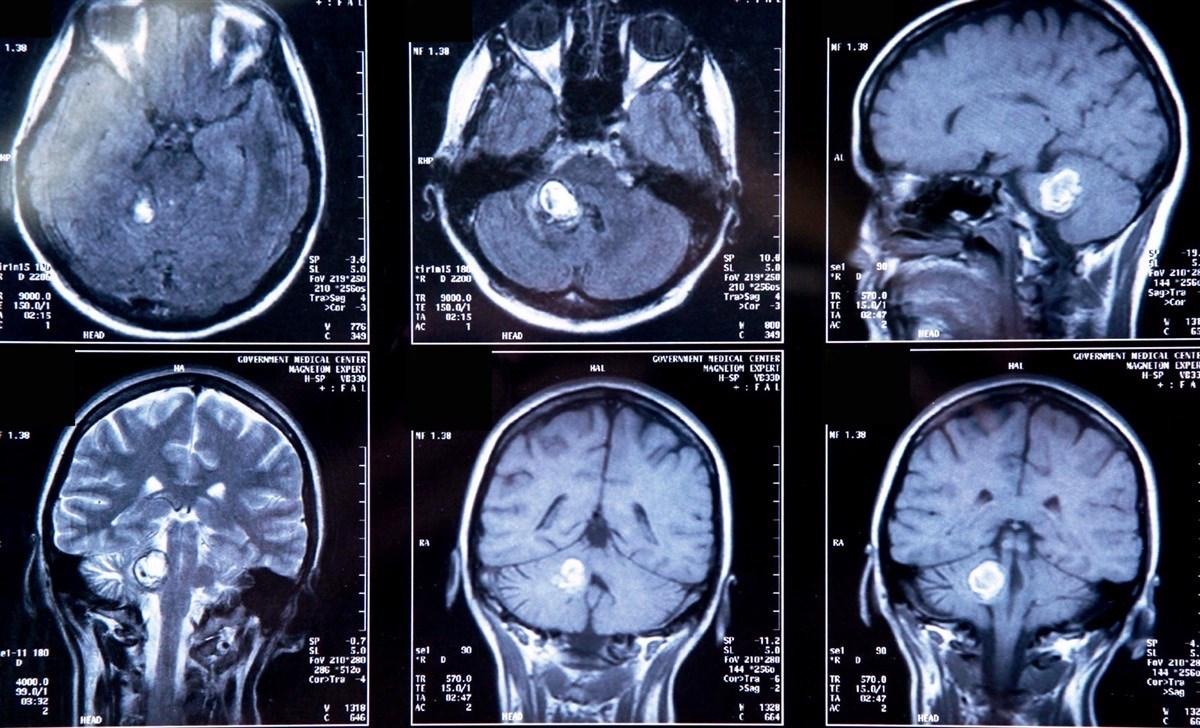 Открытие трех новых подтипов опухоли головного мозга может помочь определить новые эффективные методы лечения